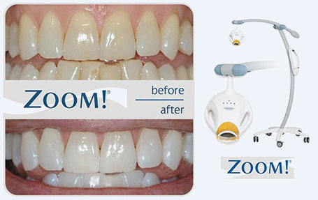 teeth-whitening-Noosaville